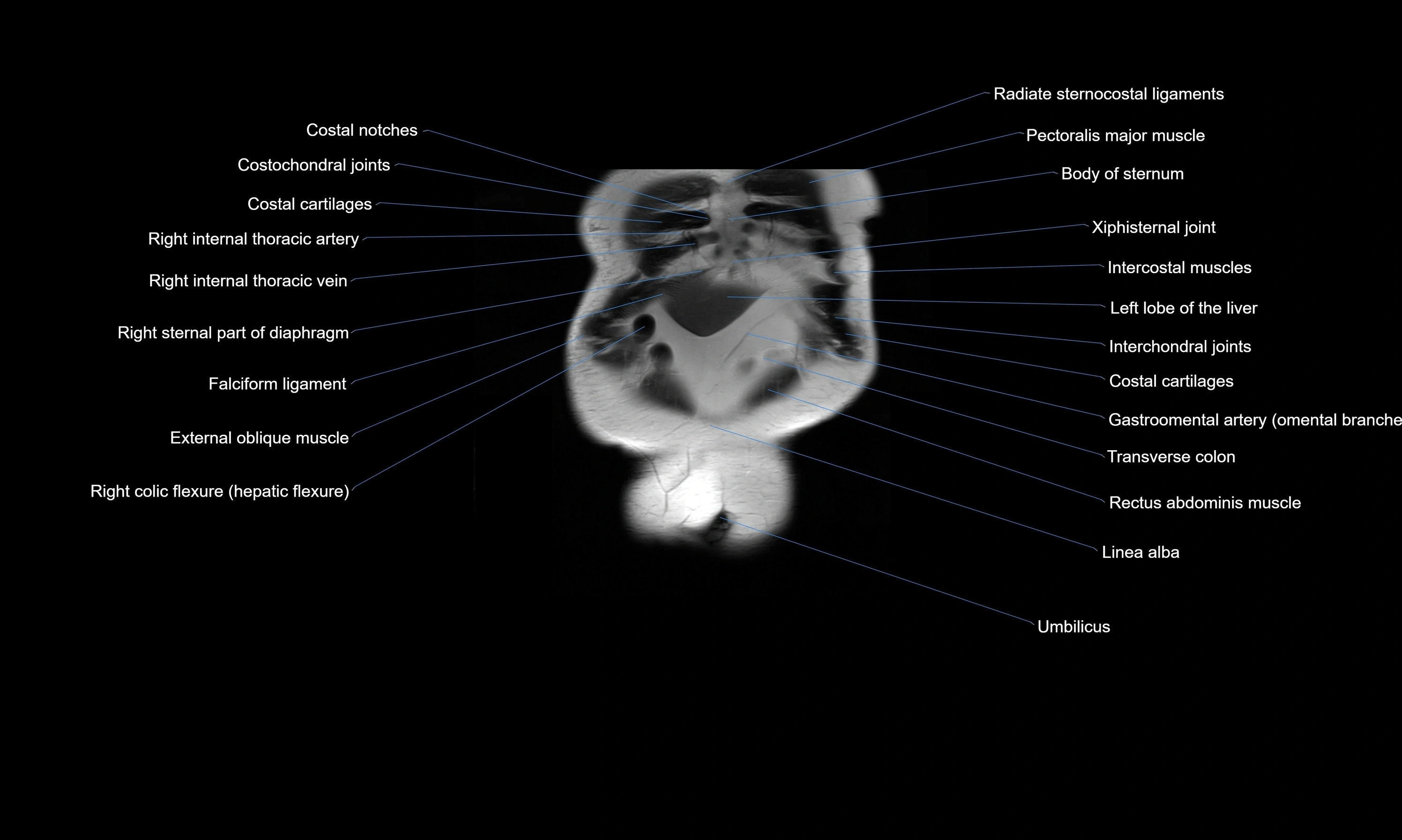 MRI Abdomen axial cross sectional anatomy radiology  image-img-00001-00007.webp